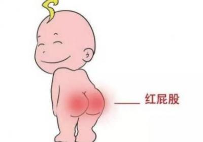 怎么护理婴幼儿臀部