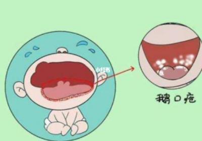 马牙和鹅口疮一样吗