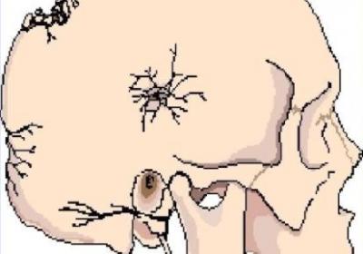 女子遭家暴，头骨开裂昏迷63天那么头骨骨裂的症状有哪些？