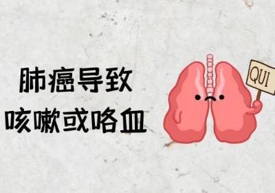 肺癌的症状有哪些？多为这几个表现