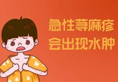 急性荨麻疹的症状有哪些？多为这几个表现