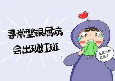 不同类型银屑病的症状表现