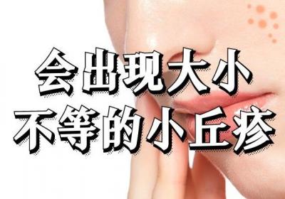 过敏性皮炎的症状是什么？以及有哪些分类