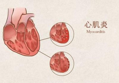 病毒性心肌炎中医辨证治疗的内容是什么？分型辩证直击诊断要点！