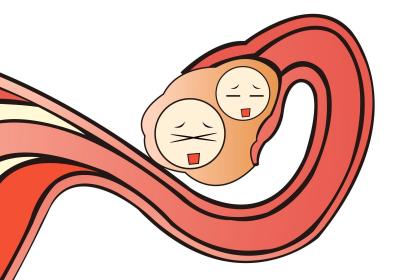 黄体破裂的因素有哪些？黄体破裂是怎么回事？