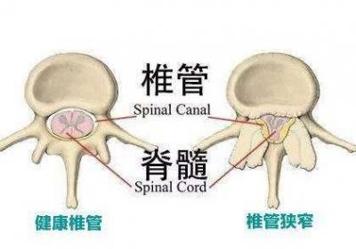 什么是腰椎管狭窄？腰椎管狭窄的症状是什么？
