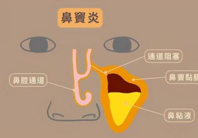 什么是鼻窦炎，以及鼻窦炎有哪些症状呢？