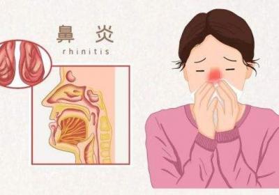除了流鼻涕，鼻炎的症状还有哪些？