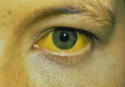 导致眼睛发黄的原因是什么？这4个原因你肯定想不到！