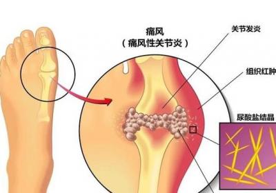 痛风性关节炎症状有哪些，如何及时发现？