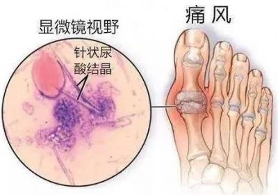 引发痛风性关节炎的原因有哪些