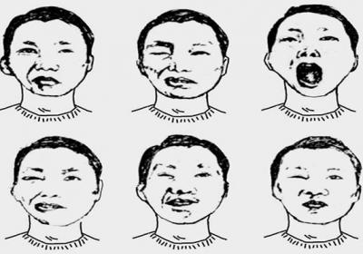 梅杰综合征中医辨证是什么