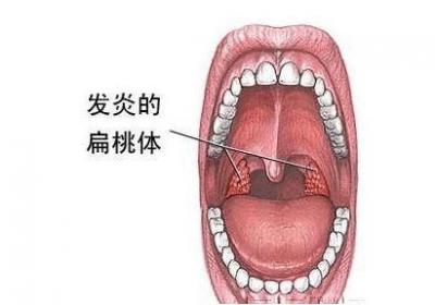 扁桃体发炎时可以用碘伏治吗