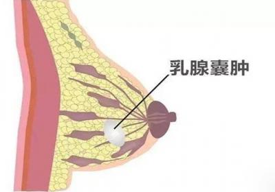 乳腺囊肿与增生之间有区别吗