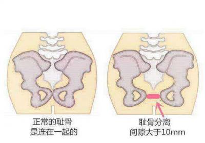 孕晚期耻骨痛的厉害是怎么回事呢