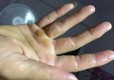 手心经常起红点是怎么回事？