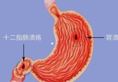 吐血是什么原因形成的？