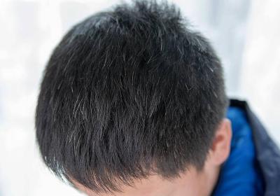须发早白如何改善呢？