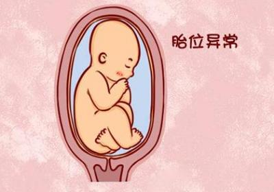 胎位不正的常见分类有哪些