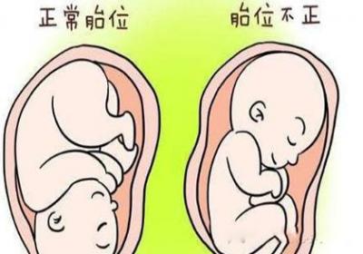 什么是胎位不正