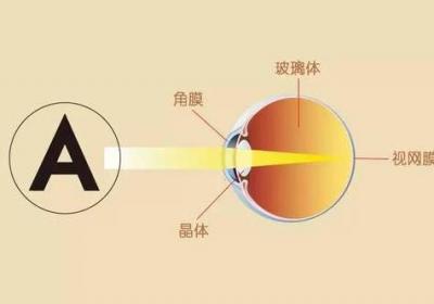 暴盲常见症状类型