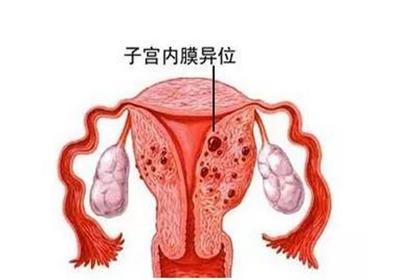 引发痛经的疾病因素