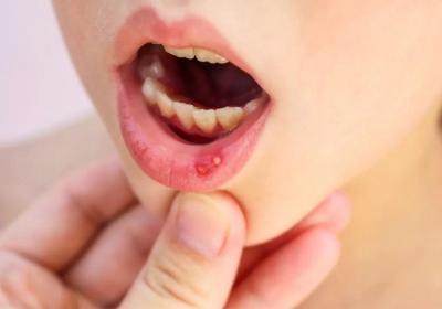 复发性口腔溃疡的危害