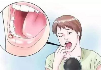 如何治疗复发性口腔溃疡？