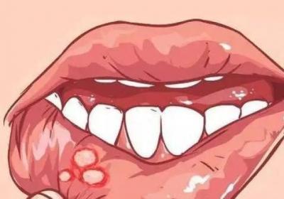 复发性口腔溃疡的原因