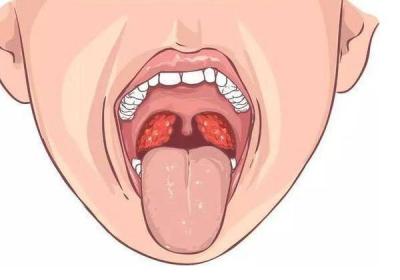 扁桃体炎产生的危害