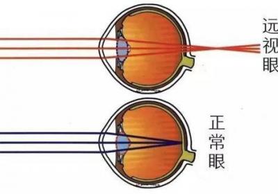如何预防远视？