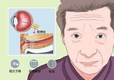 视神经萎缩的类型
