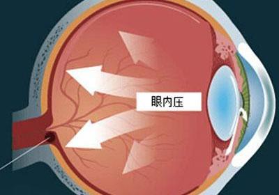 诱发青光眼的因素