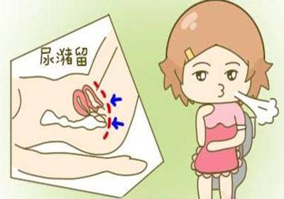 中医揿针埋刺治疗产后尿潴留