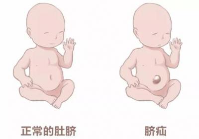 有效治愈小儿脐突