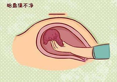 引发产妇恶露不绝的原因有哪些