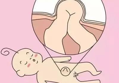 小儿脐突怎么办？