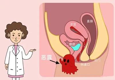 中西医分析产后恶露不绝的因素