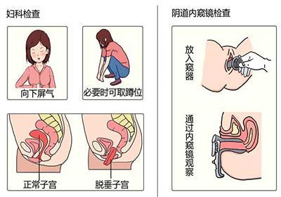 子宫脱垂可以自愈吗