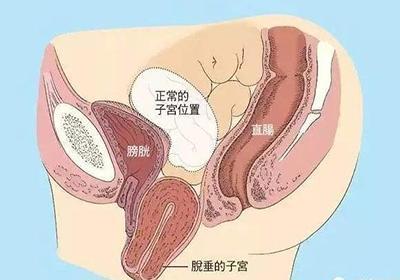 什么是子宫脱垂