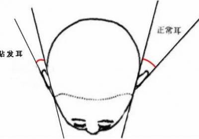 如何改善贴发耳问题？余文林：玻尿酸还是手术矫正